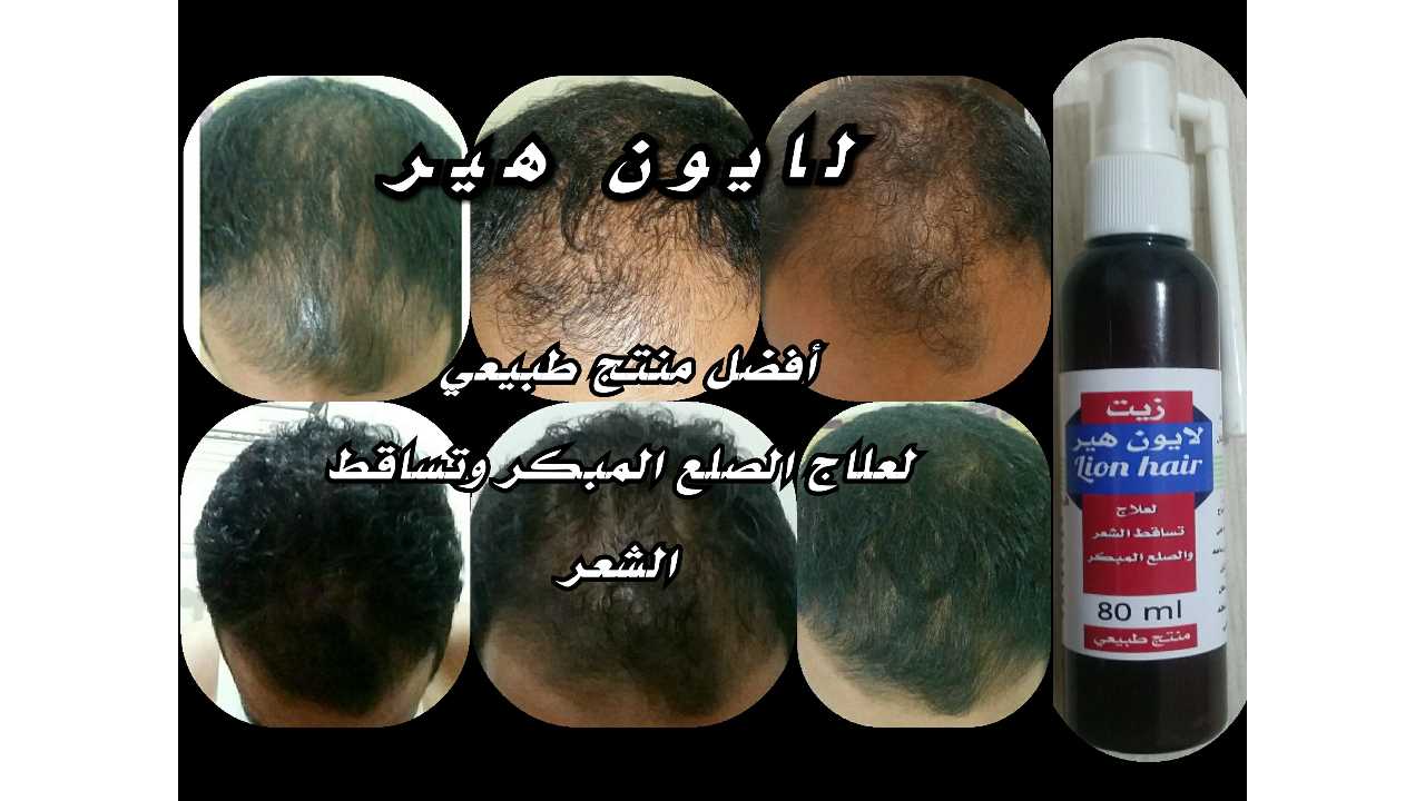 علاج الصلع المبكر وتساقط الشعر وفراغات الشعر