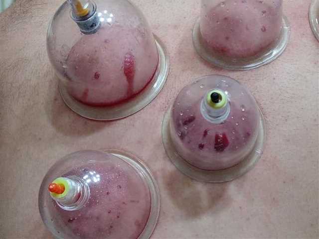 أخصائي تدليك و حجامة و ابر صينية